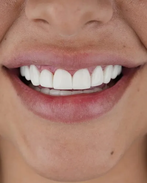 Sonrisa de una paciente de Smile Dental Center